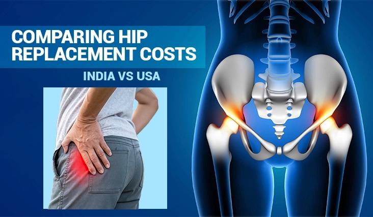 Comparing Hip Replacement Costs: India vs. USA