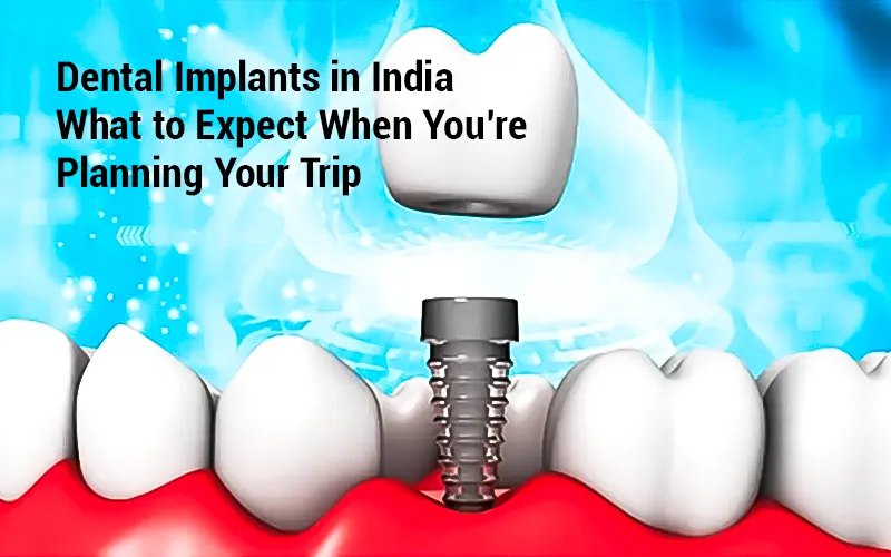 Dental Implants in India: What to Expect When You’re Planning Your Trip