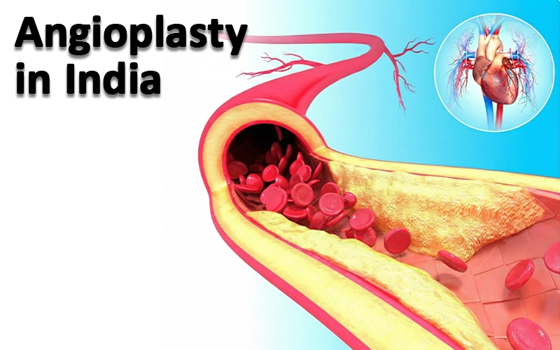 Angioplasty in India: Is Precision Cardiac Care Abroad Finally Within Reach for International Patients?