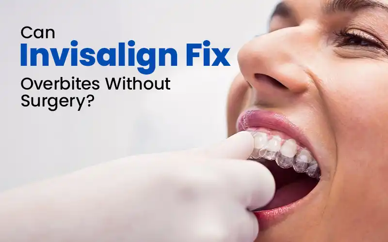 Can Invisalign Fix Overbites Without Surgery?