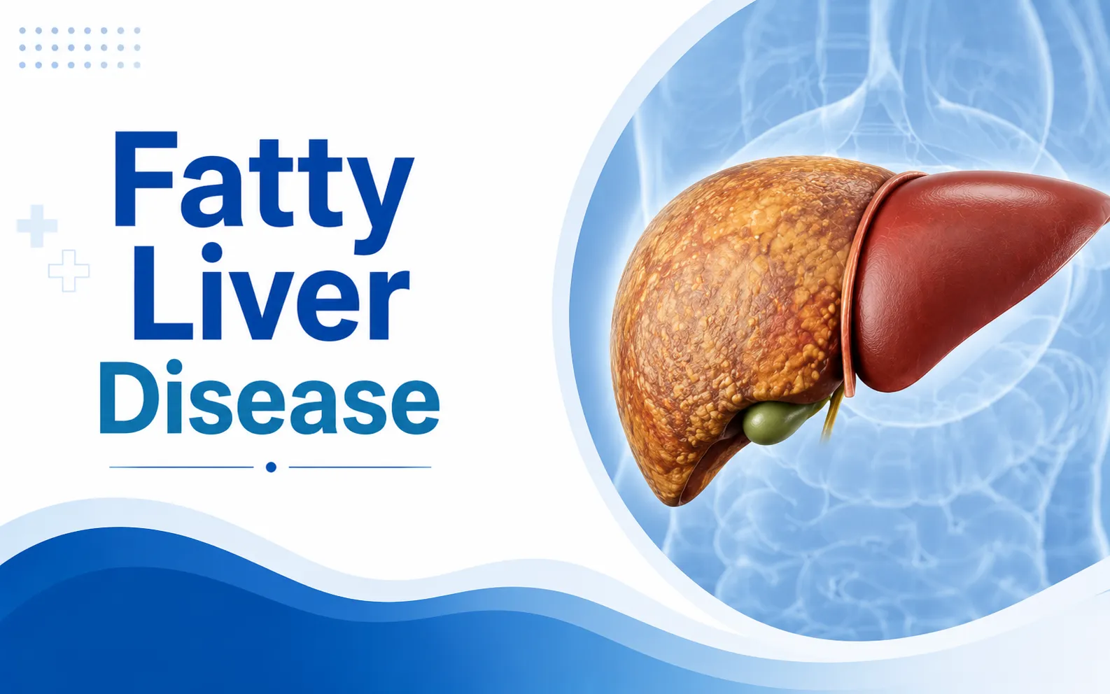 Fatty Liver Disease: The Silent Condition Now Showing Up in Younger Patients