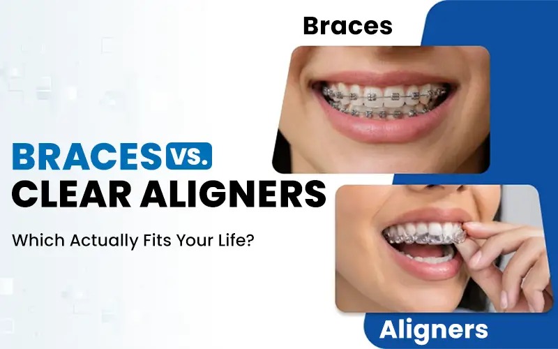 Braces vs. Clear Aligners: Which Actually Fits Your Life?