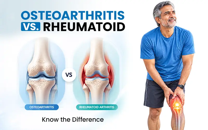 Osteoarthritis vs. Rheumatoid Arthritis: Know the Difference